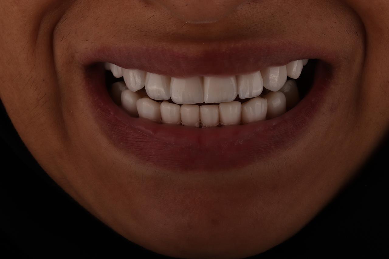 حالة قبل وبعد - تجميل أسنان